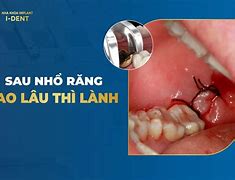 Nhổ Răng Sữa Bao Lâu Thì Mọc Lại